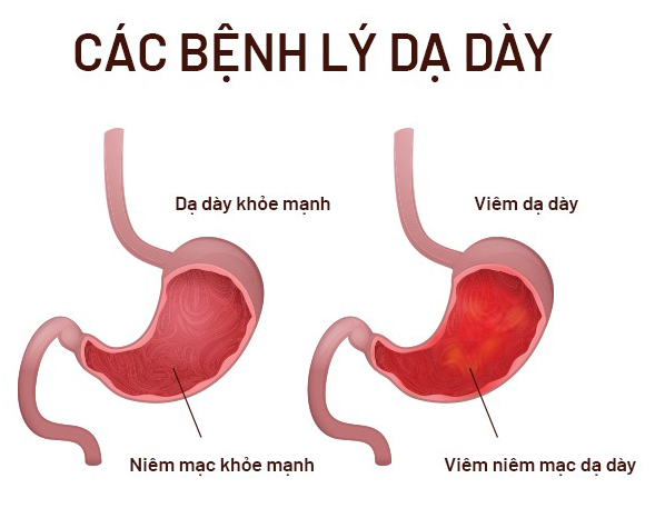 Viêm dạ dày là gì? Vì sao ăn uống rất quan trọng?