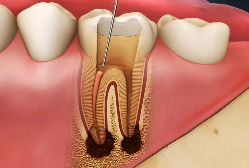 Ngăn ngừa nhiễm trùng răng miệng khi xạ trị