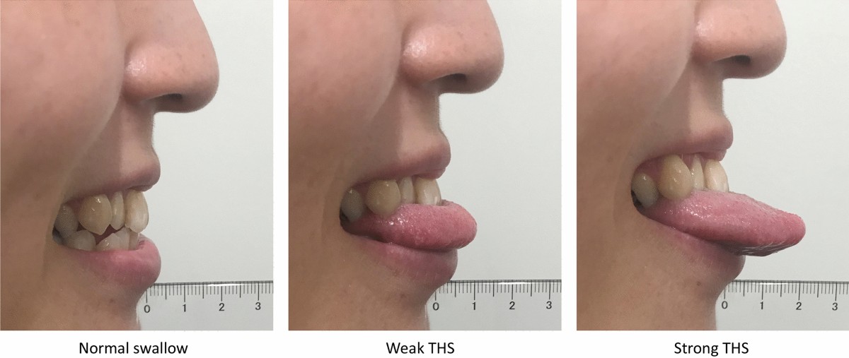 Nghiệm pháp Masako (Tongue-Hold Swallow)