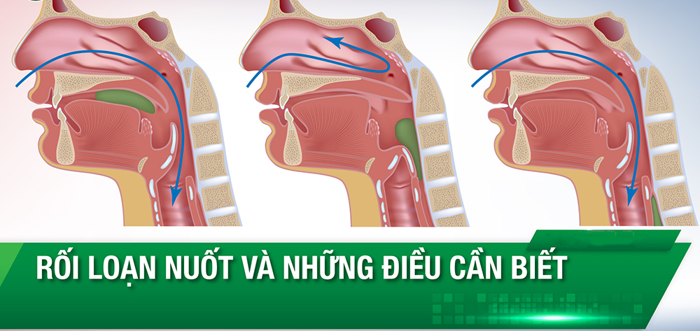 Phân độ rối loạn nuốt