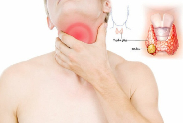Rối loạn nuốt giai đoạn họng (Pharyngeal Dysphagia) do điều trị ung thư Đầu - Mặt - Cổ