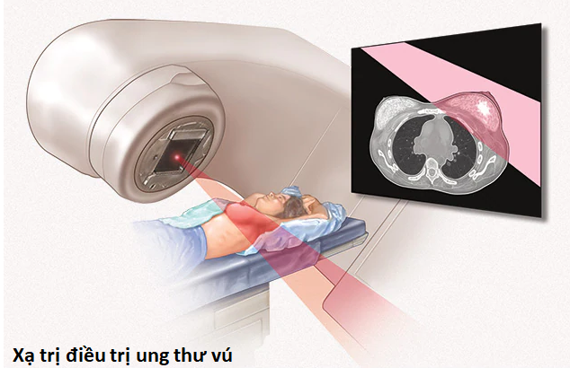 Xạ trị điều trị ung thư vú